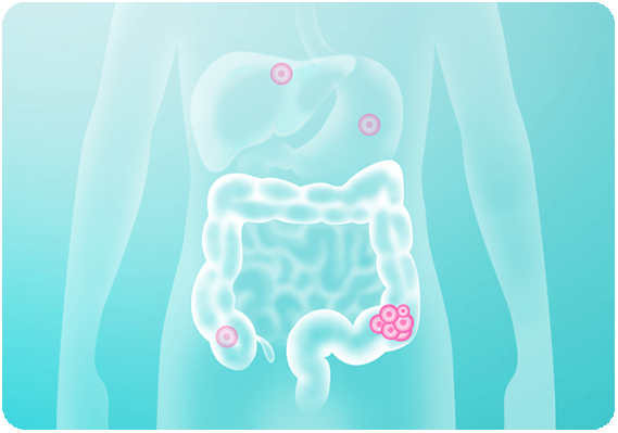 Overall survival data for STIVARGA® (regorafenib) in metastatic colorectal cancer