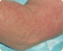 Rash