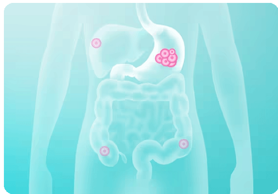 Overall survival data for STIVARGA® (regorafenib) in gastrointestinal stromal tumor